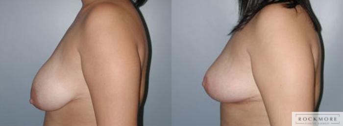 Before & After Tubular Breasts Case 103 View #3 View in Albany & Latham, New York