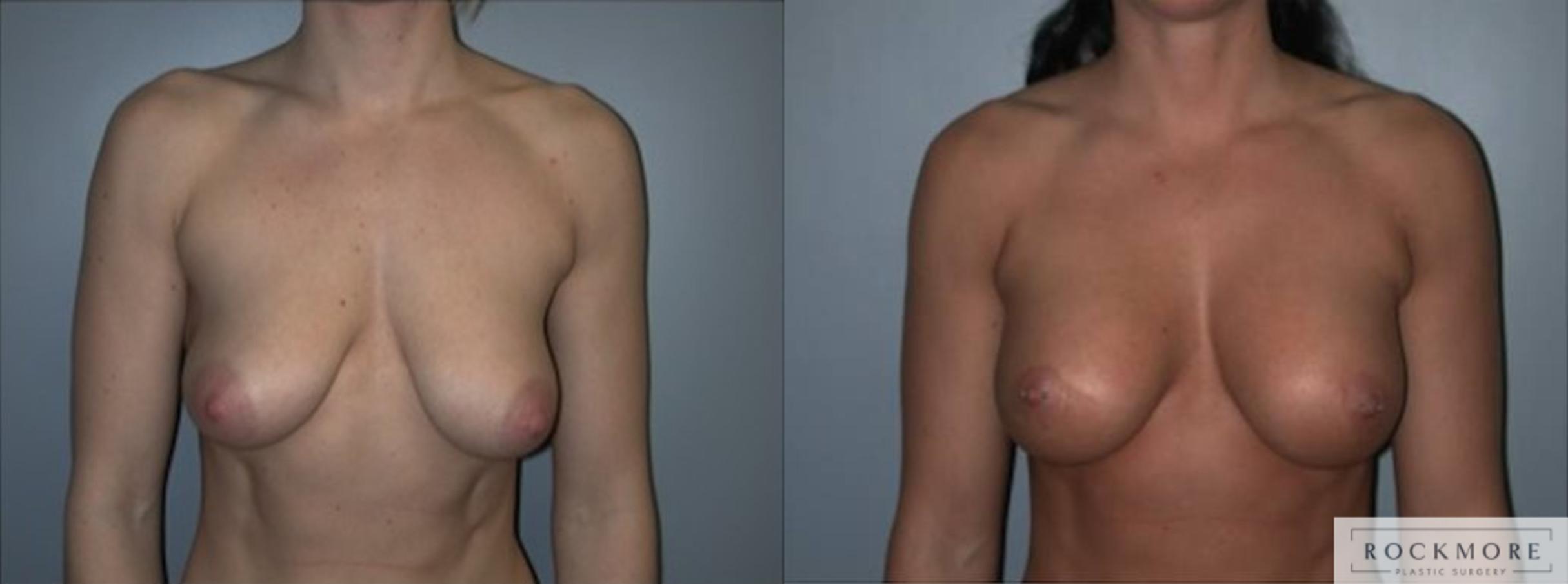 Before & After Tubular Breasts Case 122 View #1 View in Albany & Latham, New York