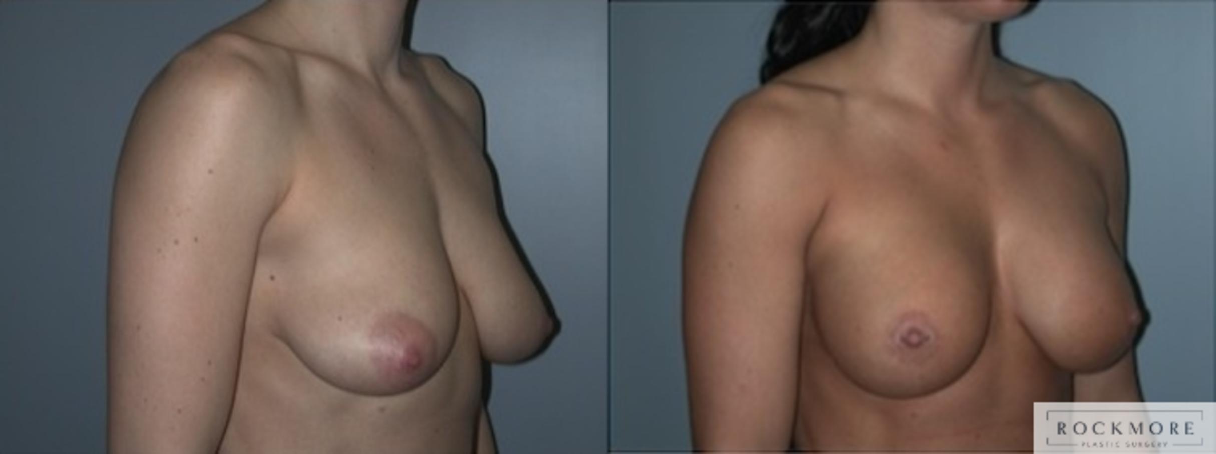 Before & After Tubular Breasts Case 122 View #2 View in Albany & Latham, New York