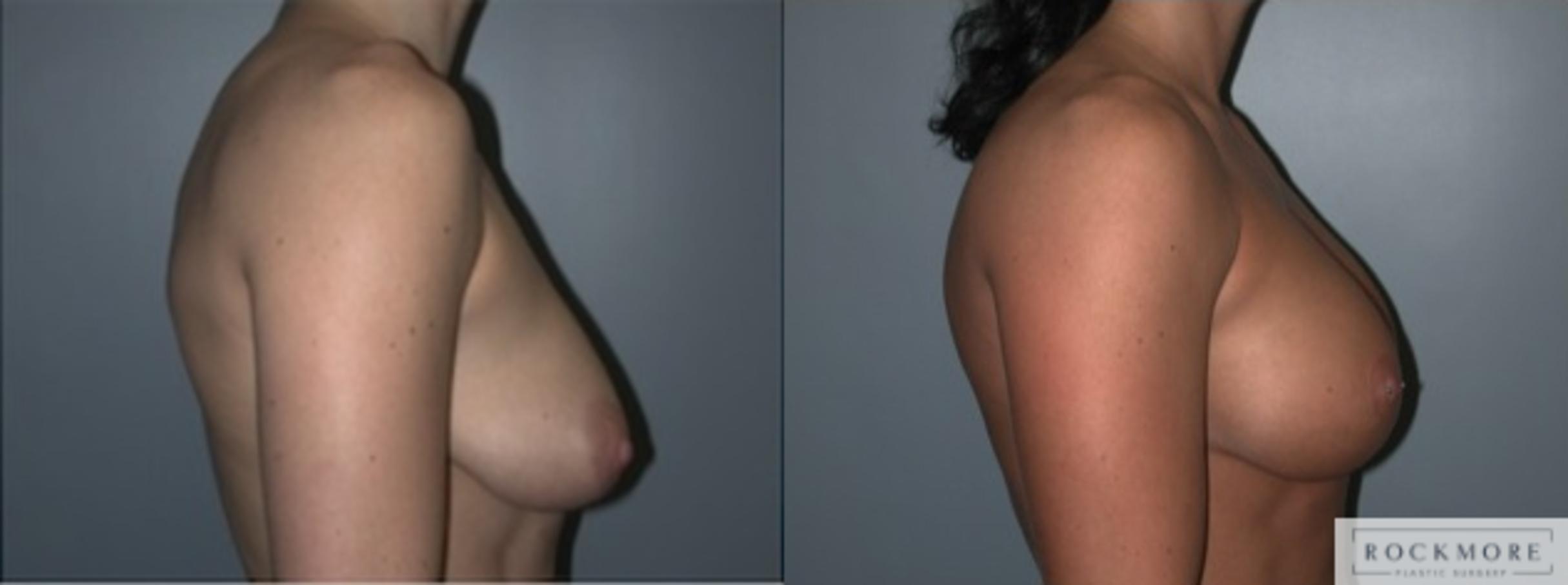 Before & After Tubular Breasts Case 122 View #3 View in Albany & Latham, New York