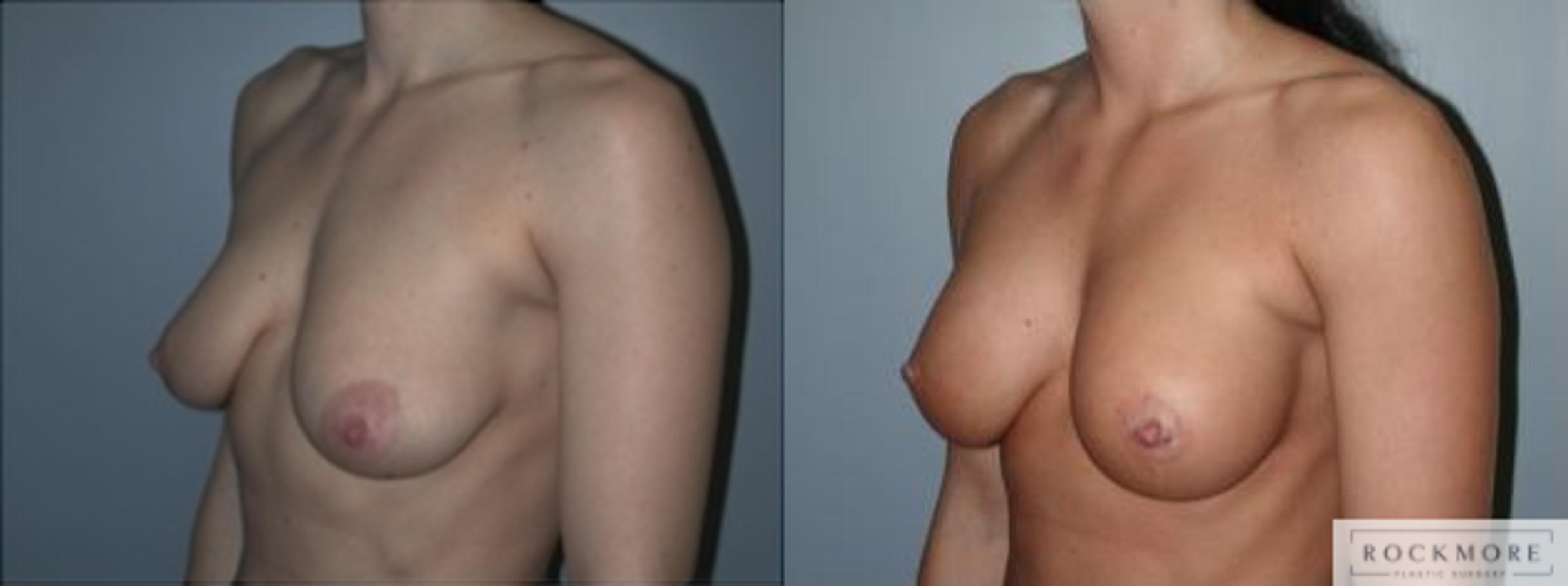 Before & After Tubular Breasts Case 122 View #4 View in Albany & Latham, New York
