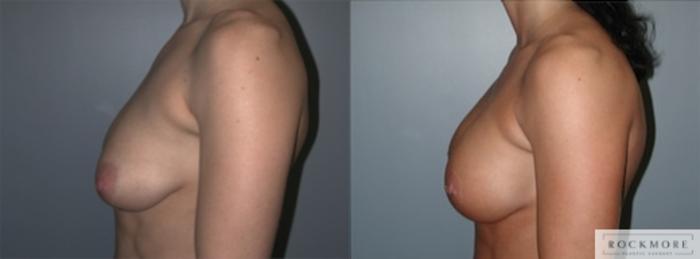 Before & After Tubular Breasts Case 122 View #5 View in Albany & Latham, New York