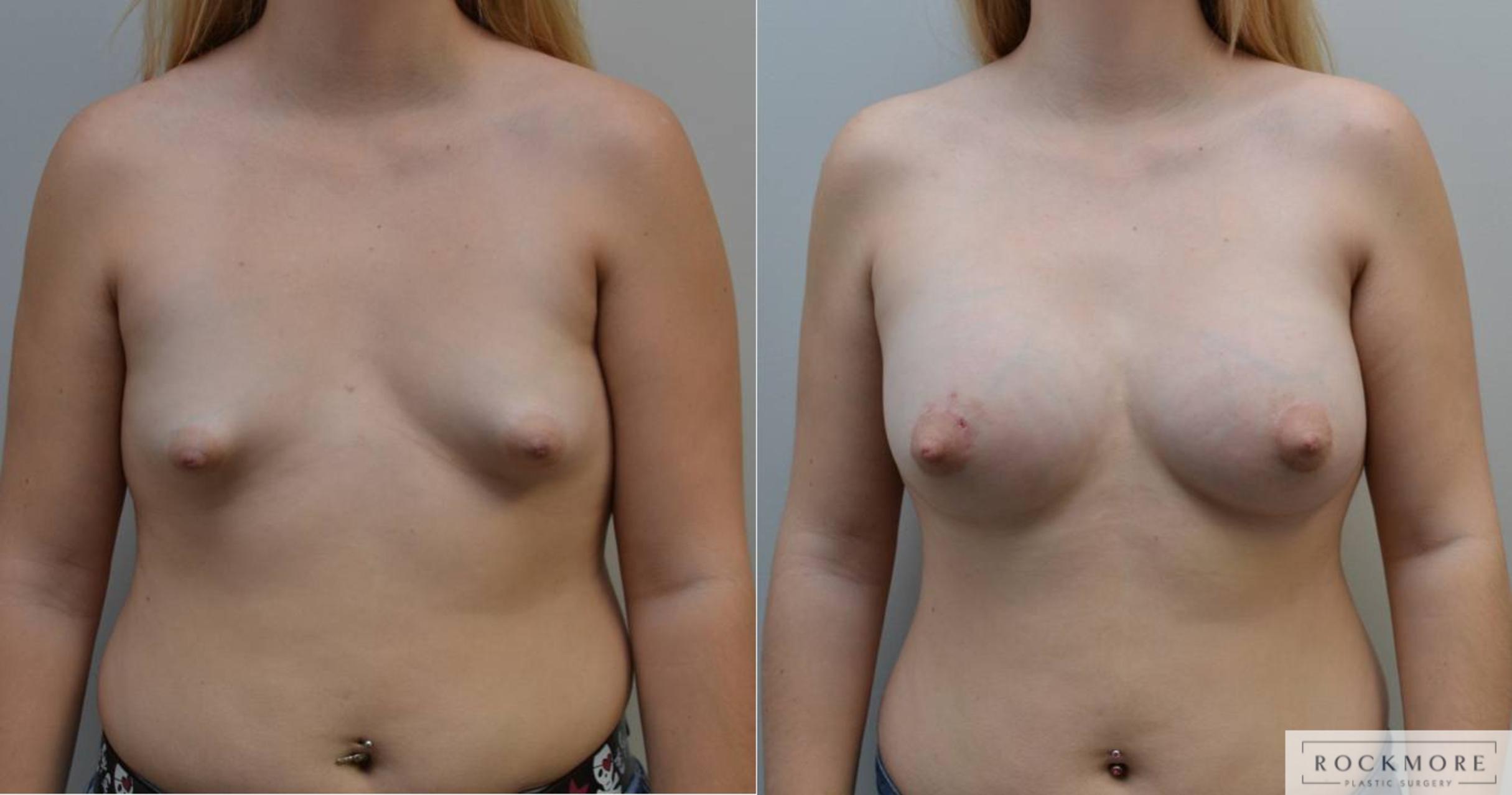 Before & After Tubular Breasts Case 198 View #1 View in Albany & Latham, New York