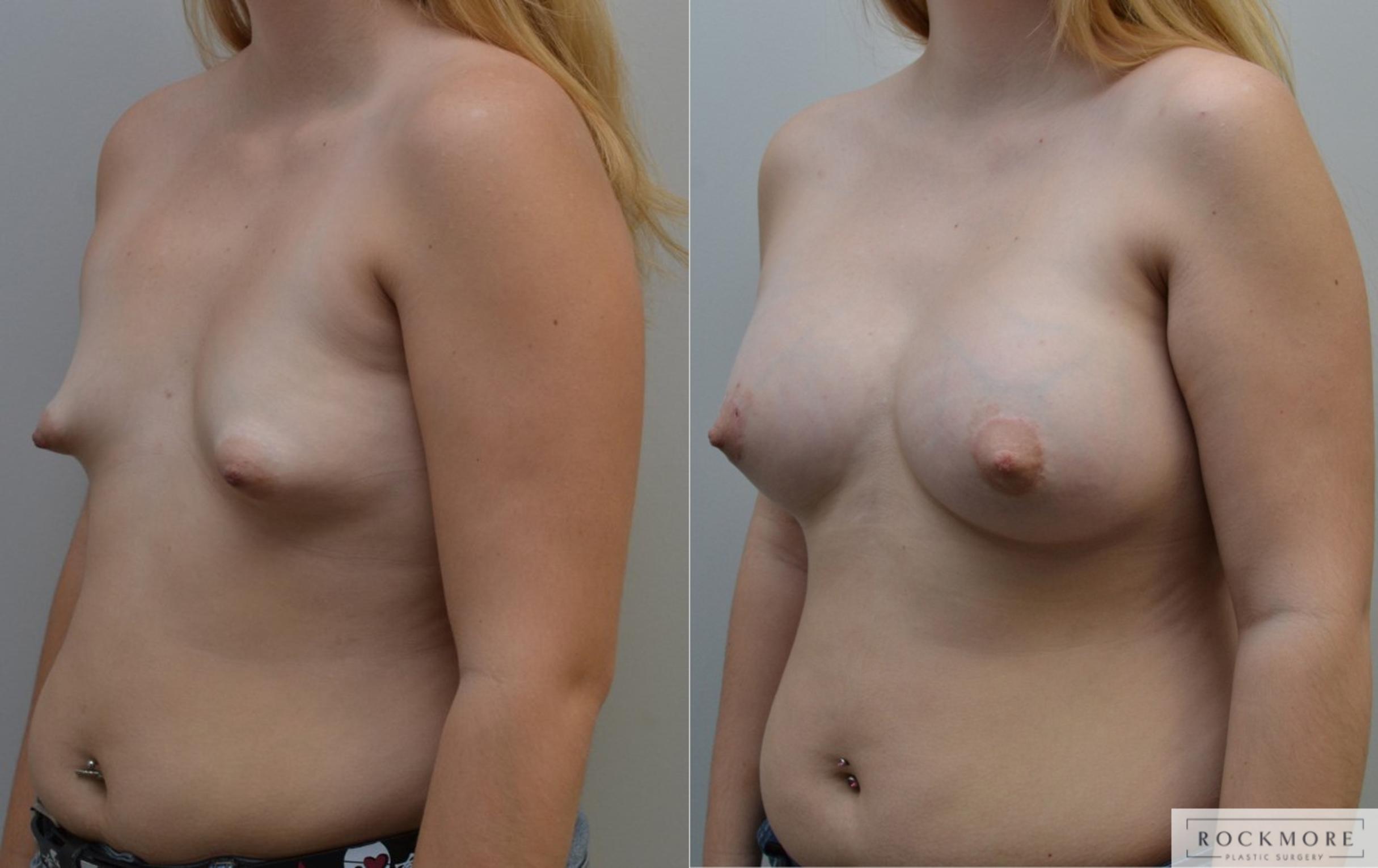 Before & After Tubular Breasts Case 198 View #2 View in Albany & Latham, New York