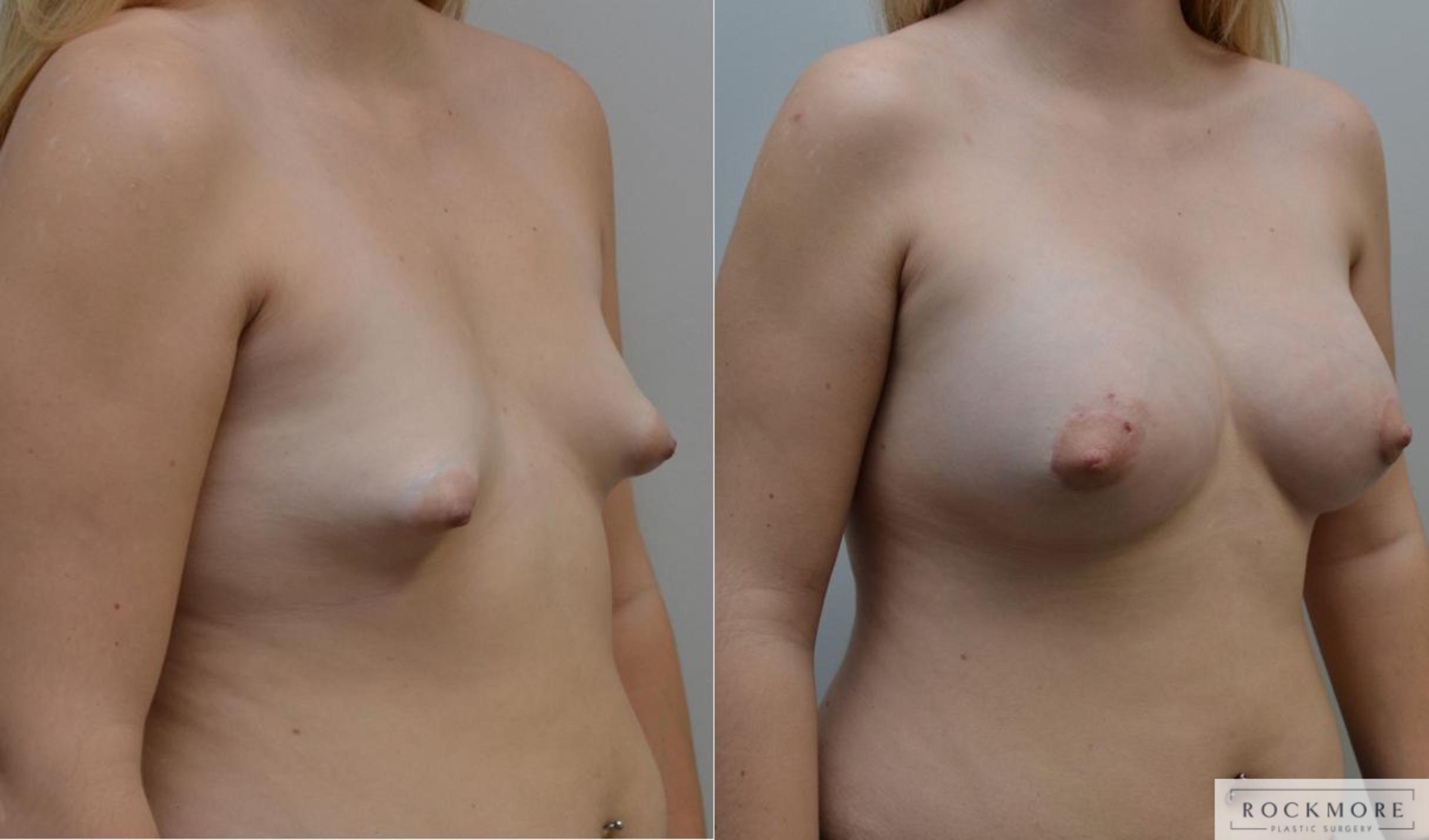 Before & After Tubular Breasts Case 198 View #3 View in Albany & Latham, New York