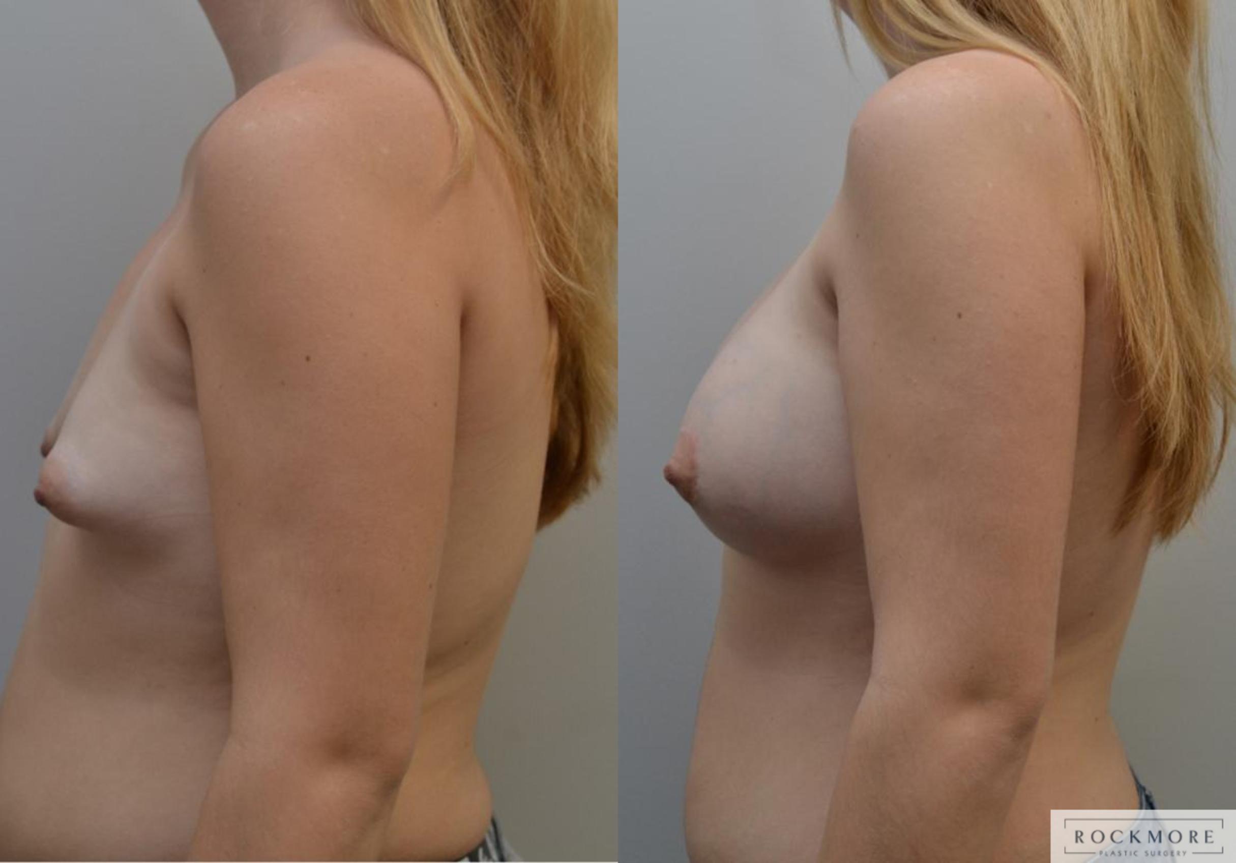 Before & After Tubular Breasts Case 198 View #4 View in Albany & Latham, New York