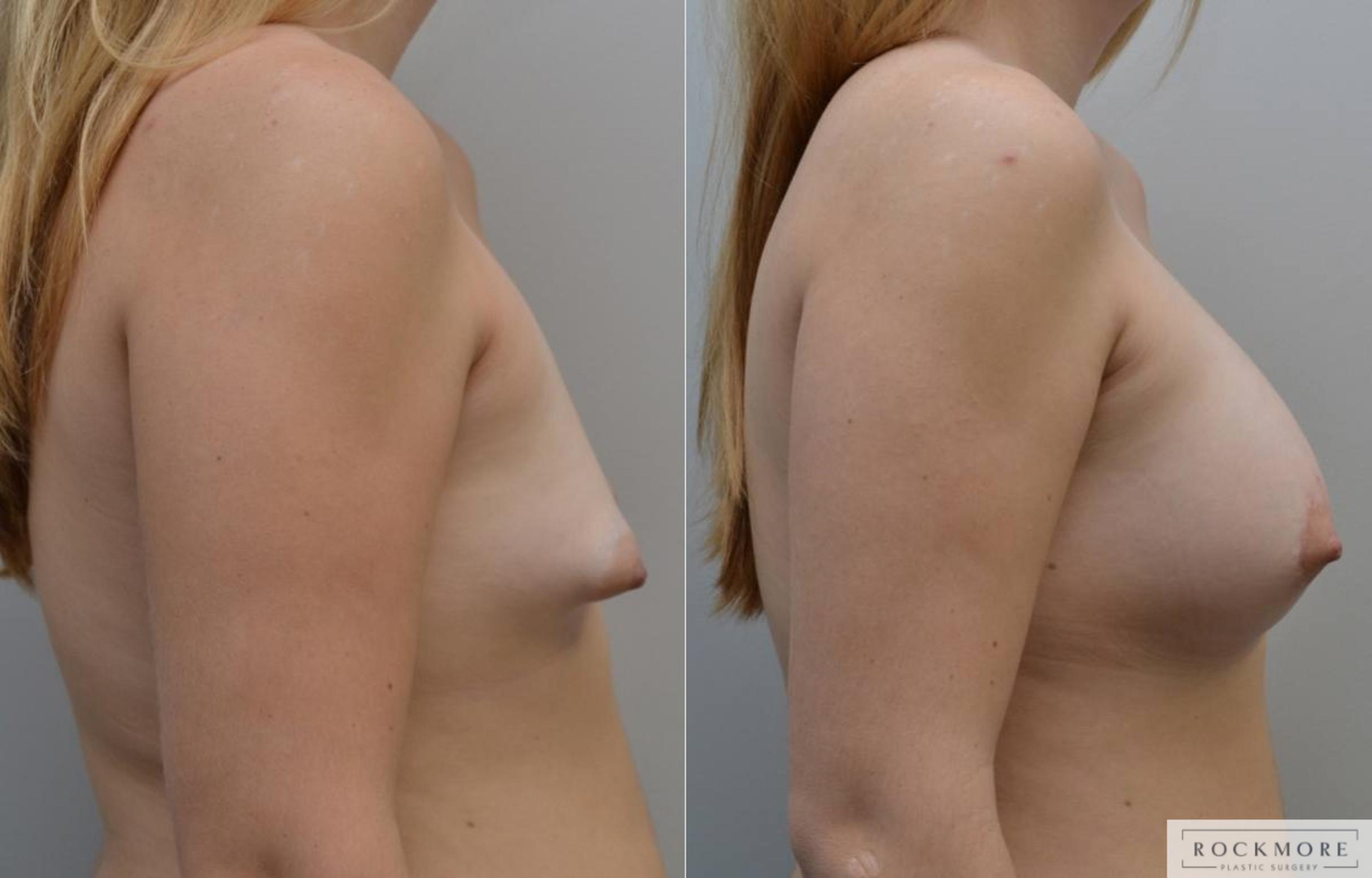 Before & After Tubular Breasts Case 198 View #5 View in Albany & Latham, New York