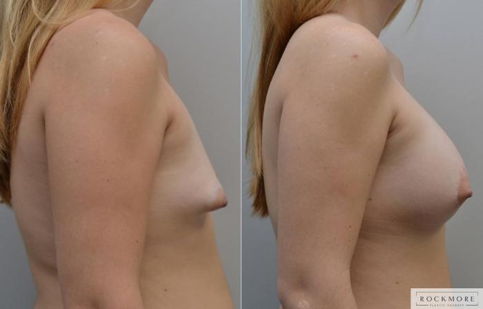Before & After Tubular Breasts Case 198 View #5 View in Albany & Latham, New York