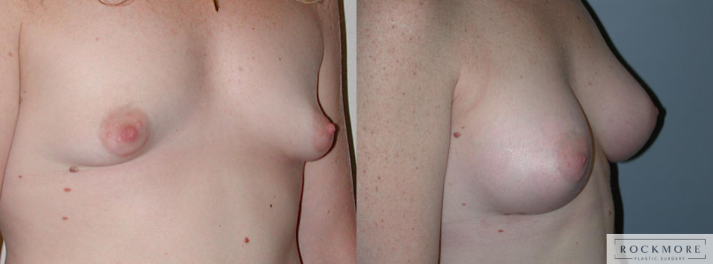 Before & After Tubular Breasts Case 45 View #2 View in Albany & Latham, New York