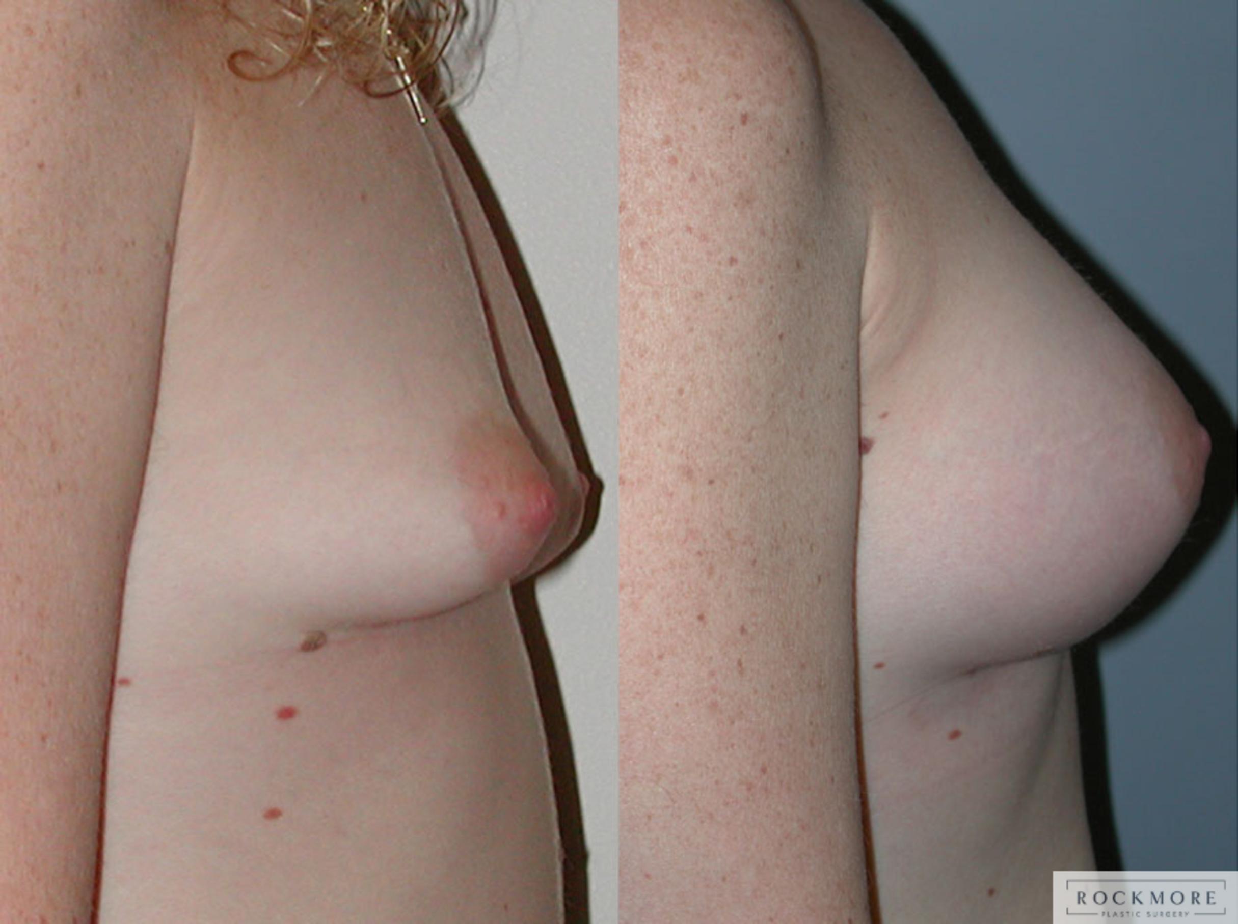 Before & After Tubular Breasts Case 45 View #3 View in Albany & Latham, New York