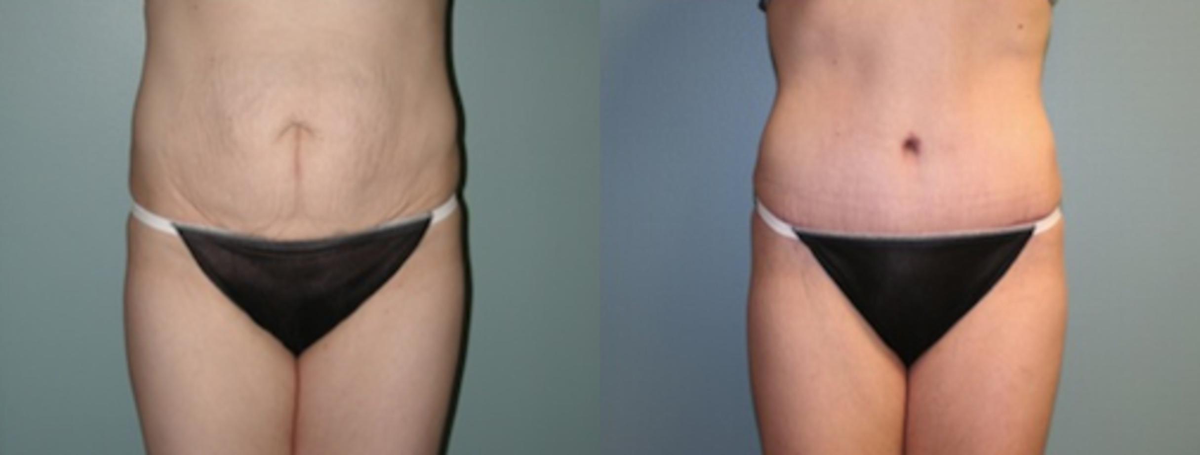 Before & After Tummy Tuck Case 136 View #1 View in Albany, Latham & Saratoga, New York