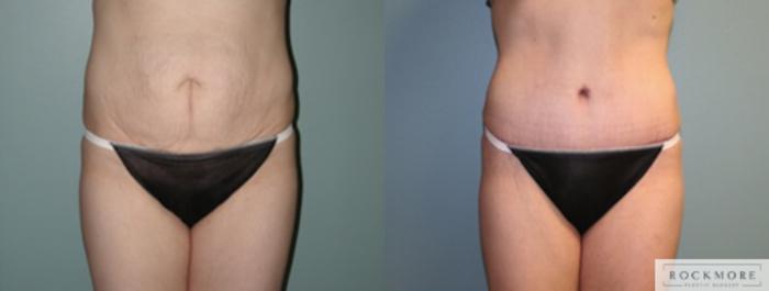 Before & After Tummy Tuck Case 136 View #1 View in Albany & Latham, New York