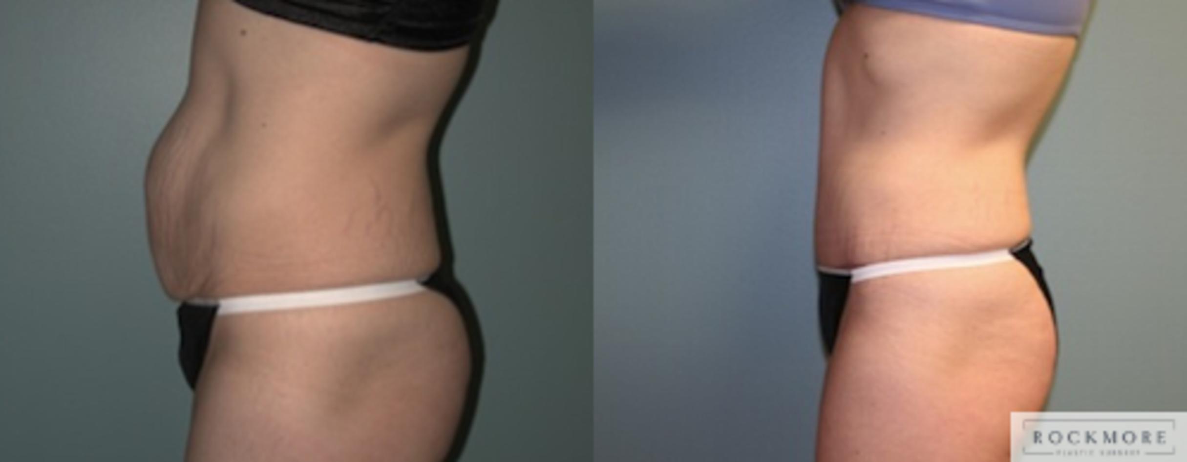 Before & After Tummy Tuck Case 136 View #2 View in Albany & Latham, New York