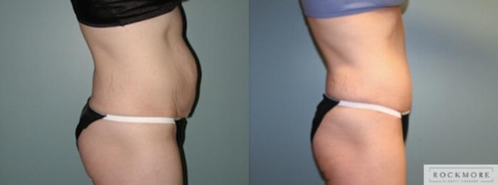 Before & After Tummy Tuck Case 136 View #3 View in Albany & Latham, New York