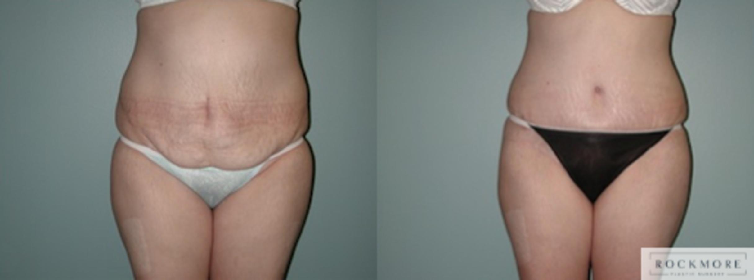 Before & After Tummy Tuck Case 137 View #1 View in Albany & Latham, New York