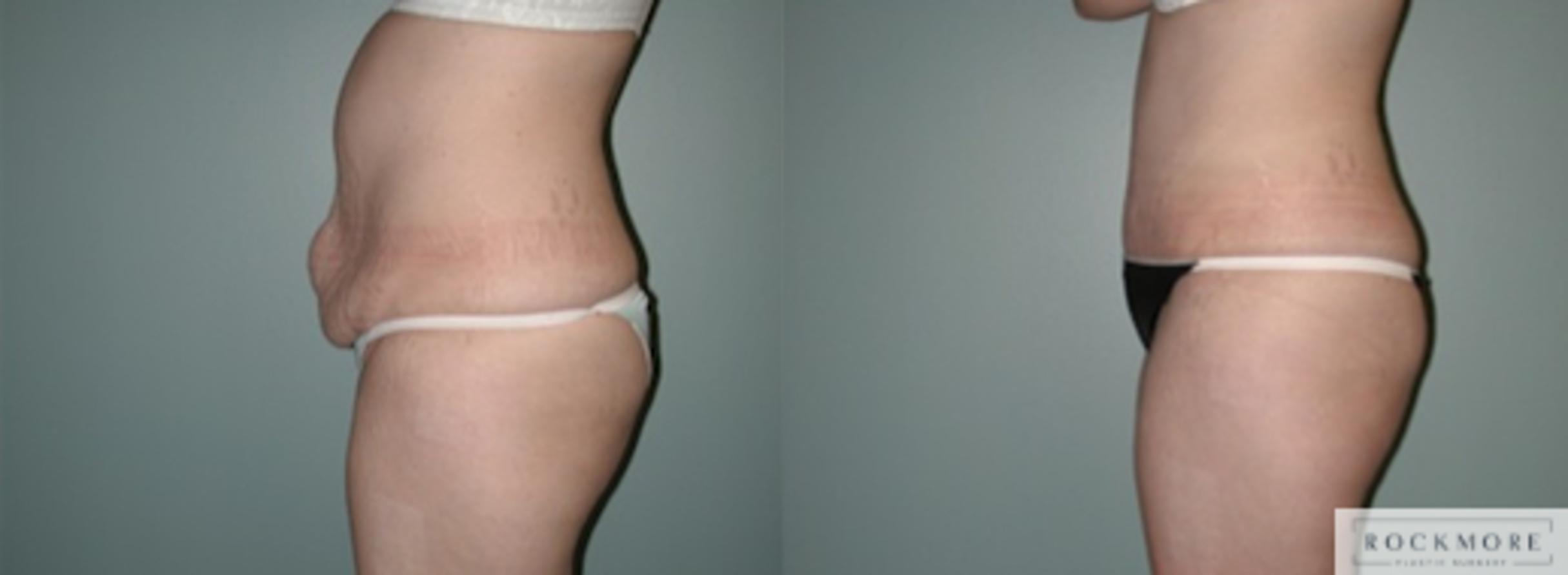 Before & After Tummy Tuck Case 137 View #2 View in Albany & Latham, New York