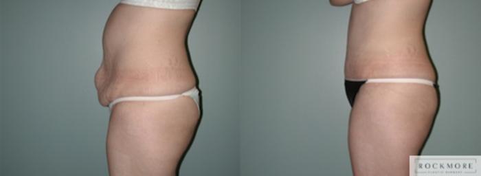 Before & After Tummy Tuck Case 137 View #2 View in Albany & Latham, New York