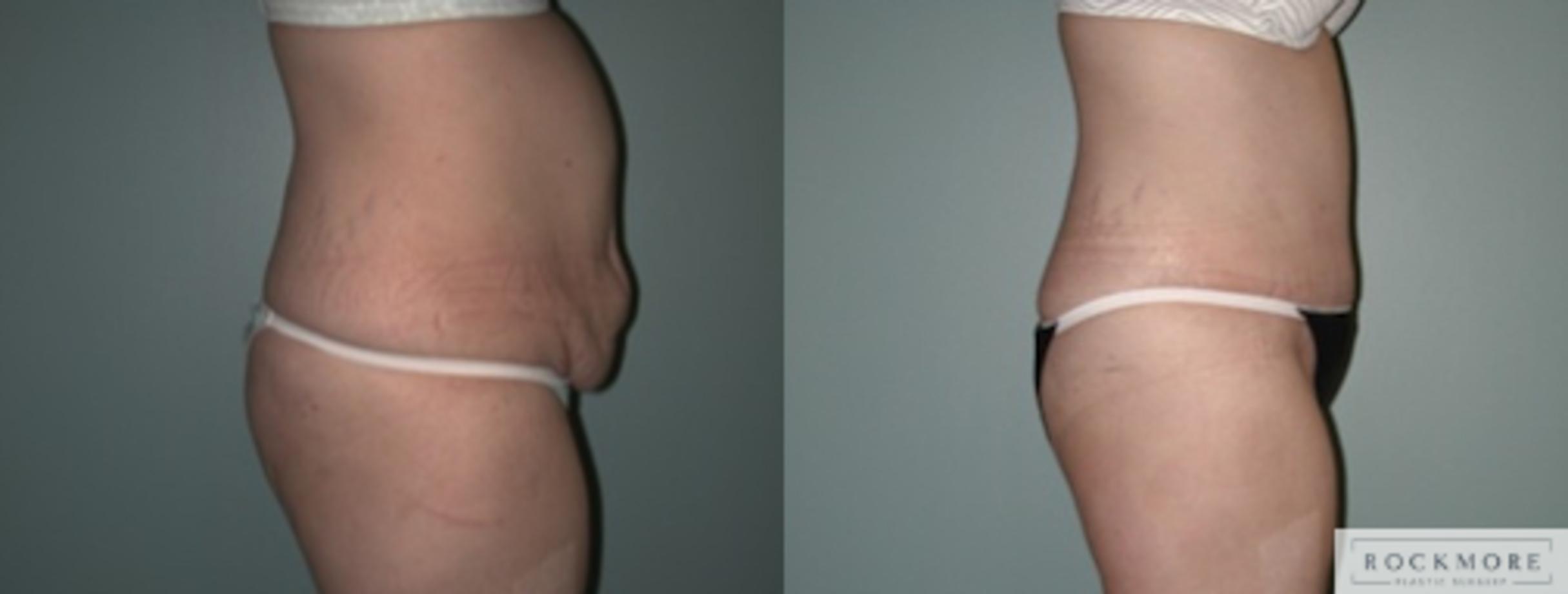 Before & After Tummy Tuck Case 137 View #4 View in Albany & Latham, New York