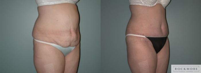 Before & After Tummy Tuck Case 137 View #5 View in Albany & Latham, New York