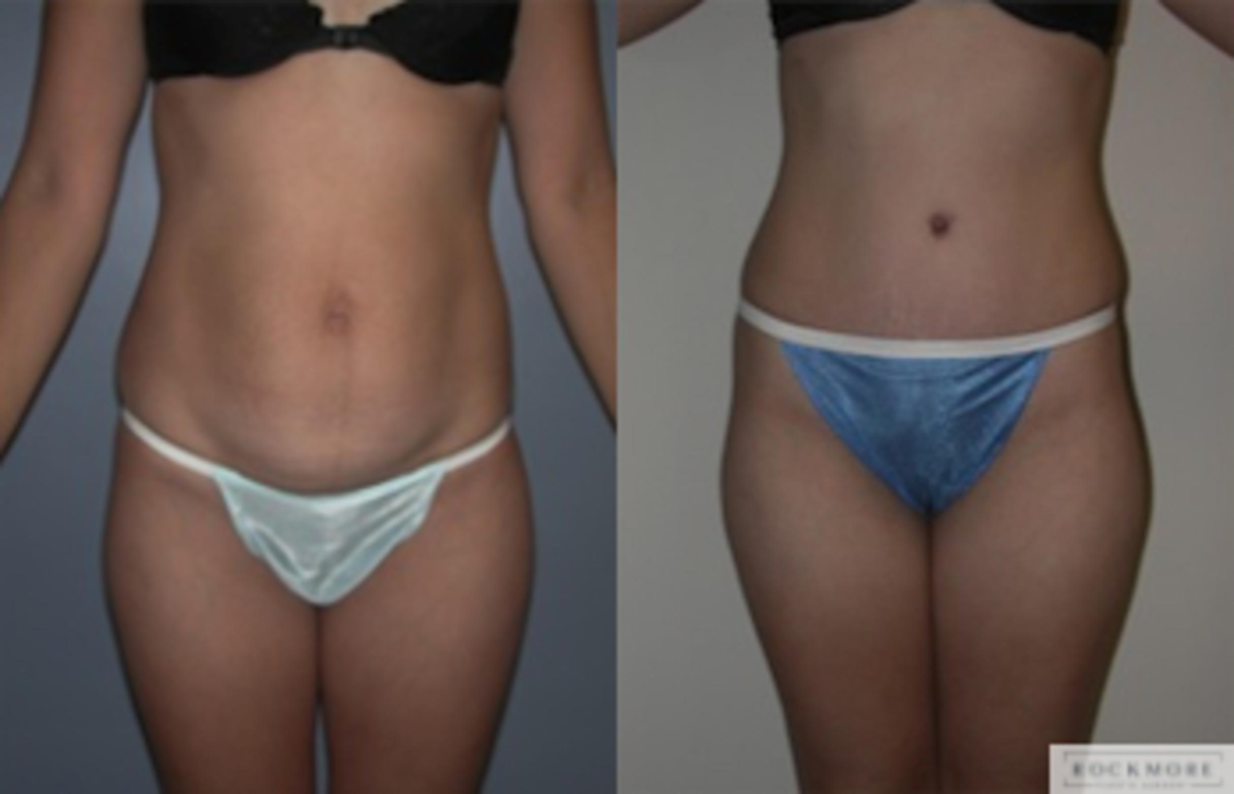 Before & After Tummy Tuck Case 139 View #1 View in Albany & Latham, New York