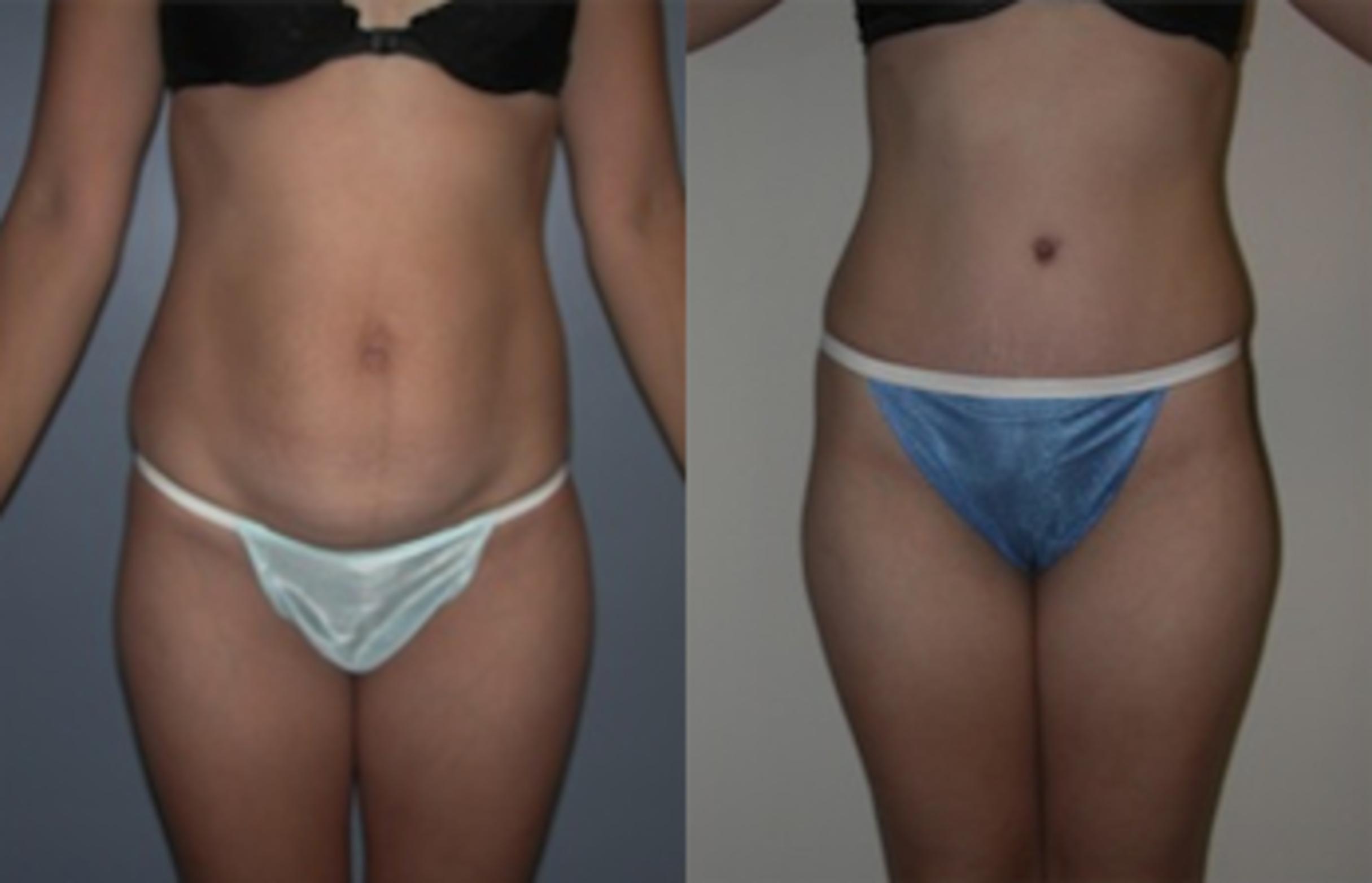 Before & After Tummy Tuck Case 139 View #1 View in Albany & Latham, New York