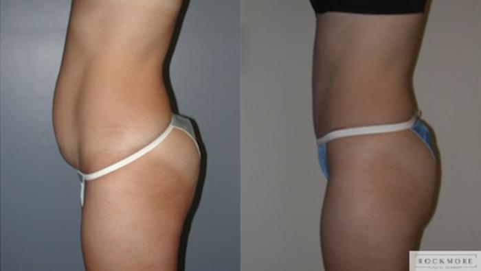 Before & After Tummy Tuck Case 139 View #2 View in Albany & Latham, New York