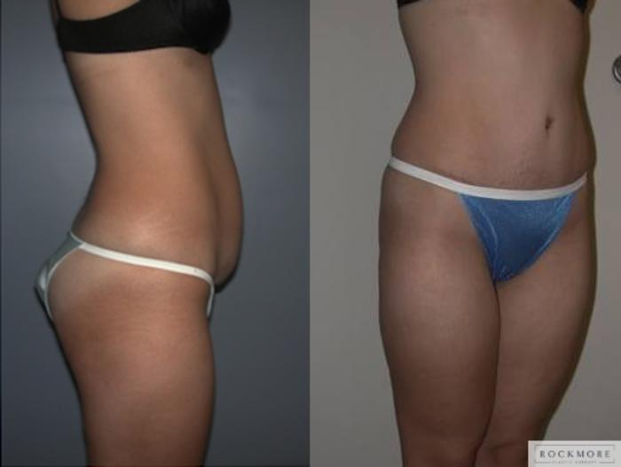 Before & After Tummy Tuck Case 139 View #3 View in Albany & Latham, New York