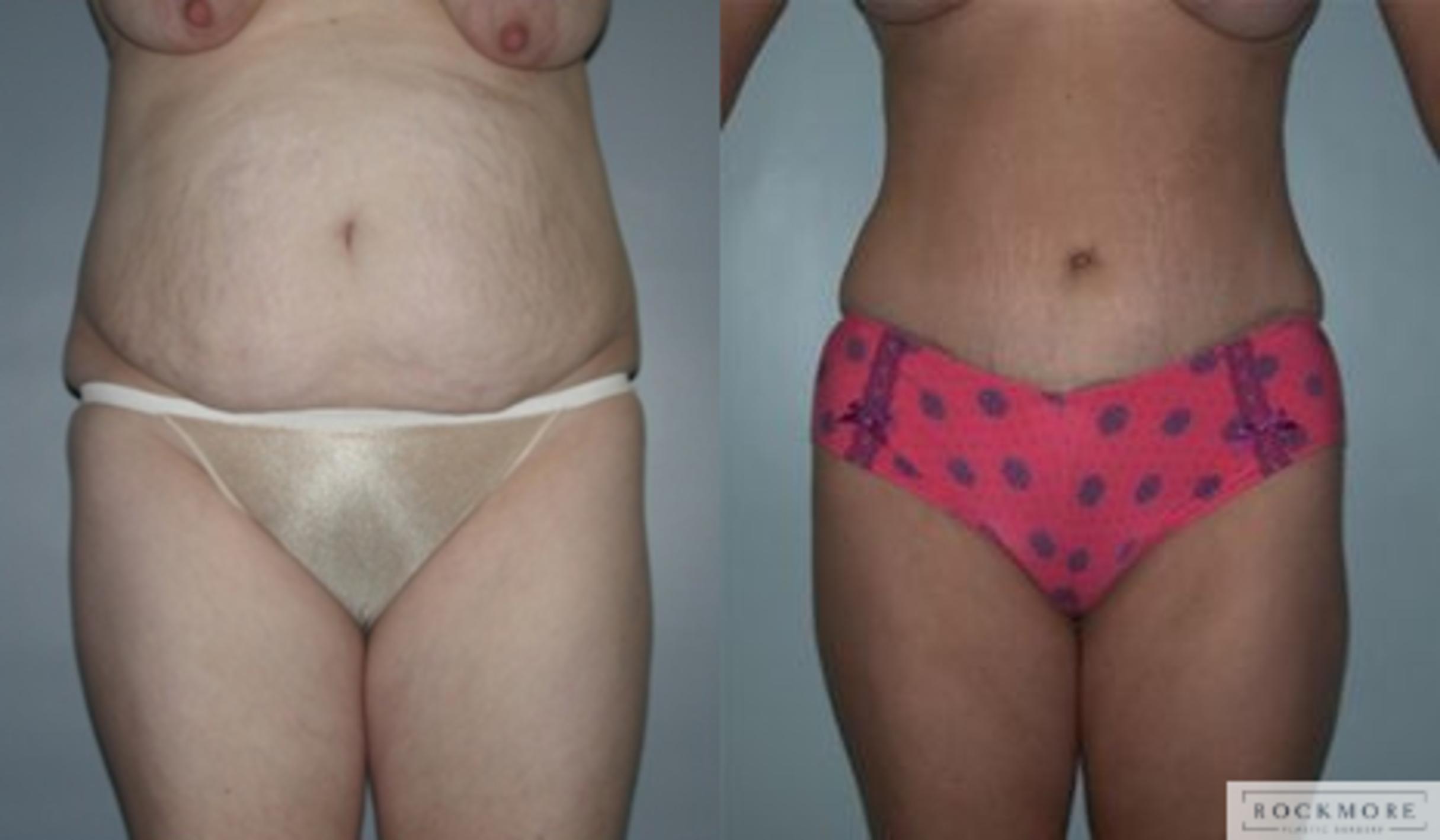 Before & After Tummy Tuck Case 141 View #1 View in Albany & Latham, New York