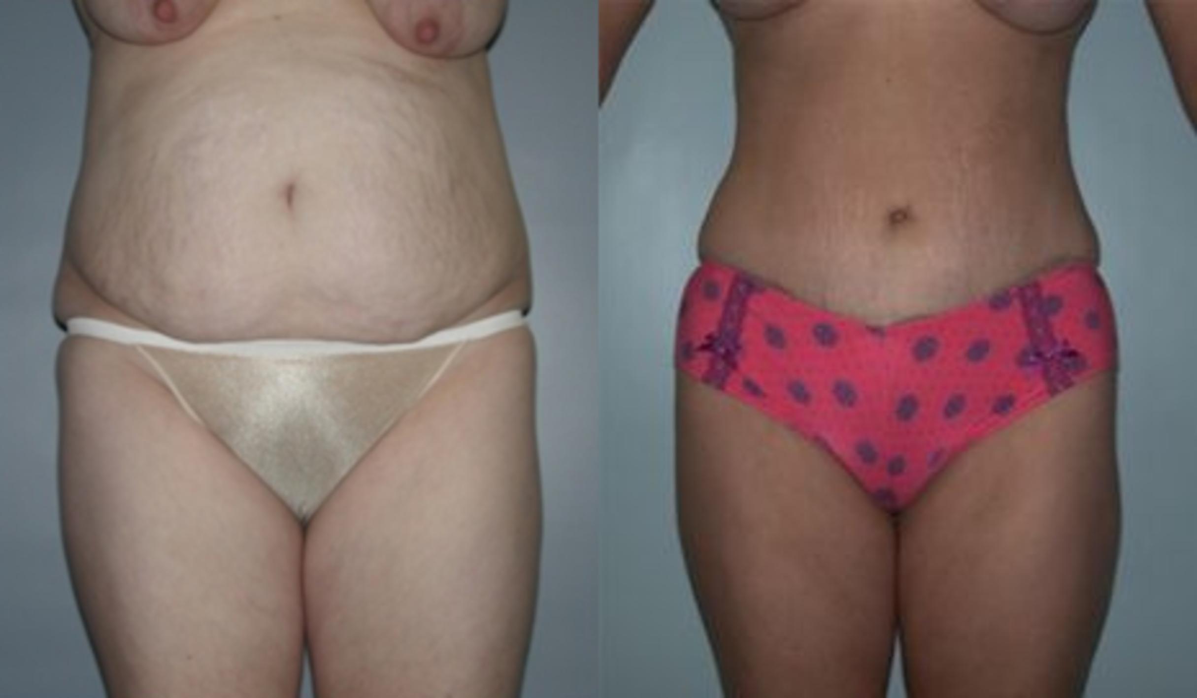 Before & After Tummy Tuck Case 141 View #1 View in Albany, Latham & Saratoga, New York