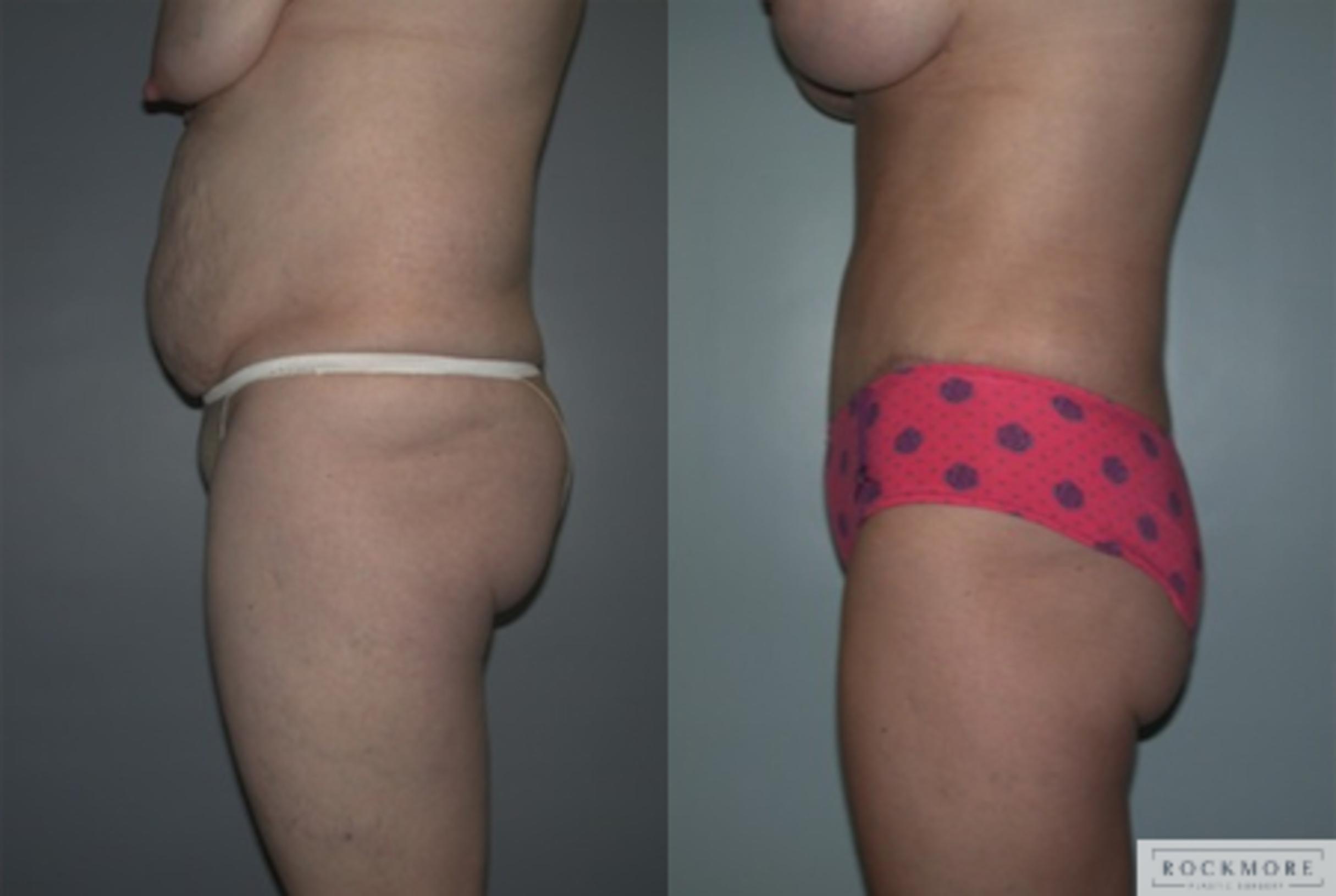 Before & After Tummy Tuck Case 141 View #2 View in Albany & Latham, New York