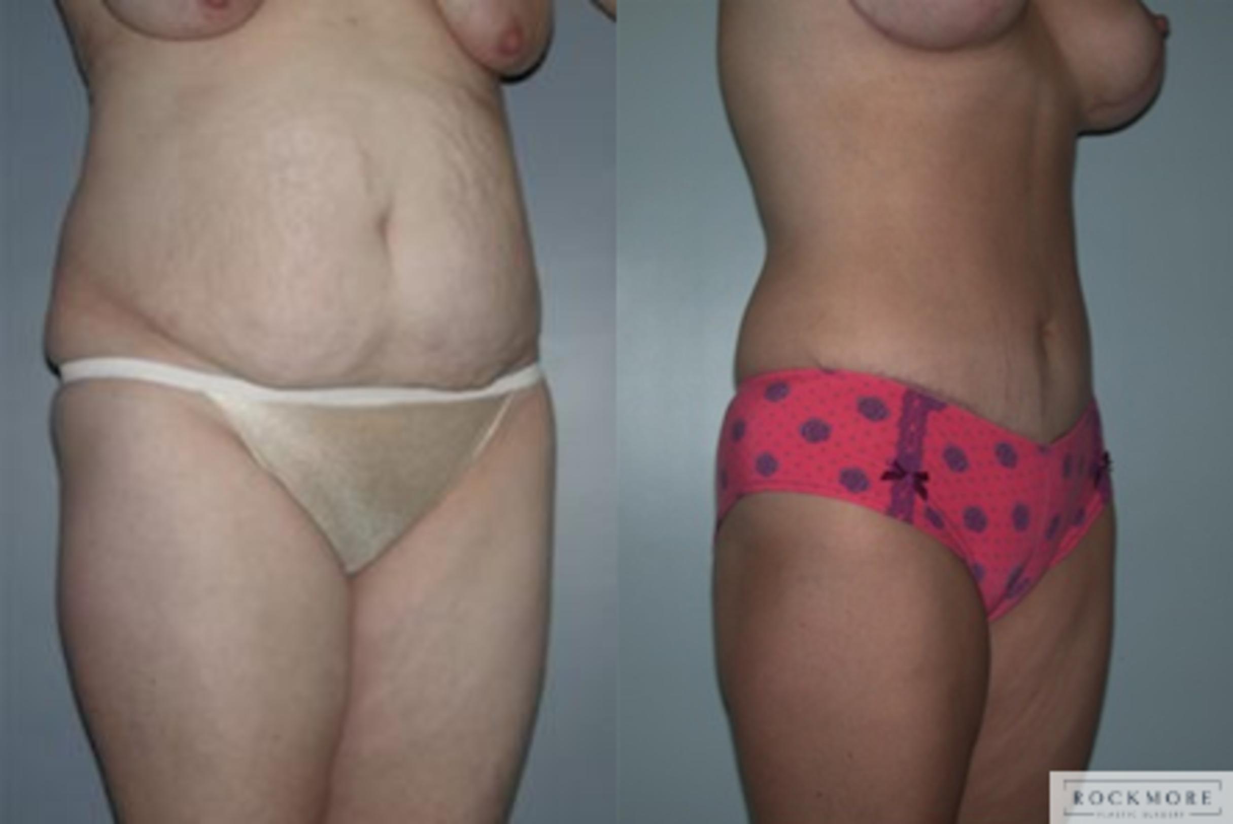 Before & After Tummy Tuck Case 141 View #3 View in Albany & Latham, New York