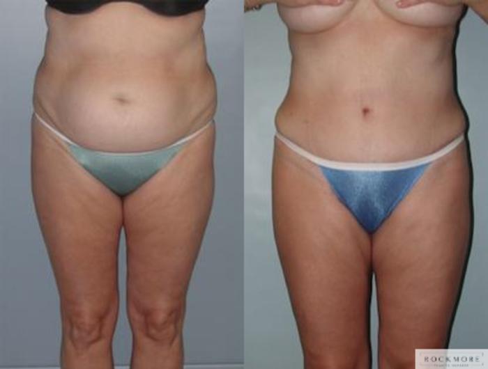 Before & After Tummy Tuck Case 142 View #1 View in Albany & Latham, New York