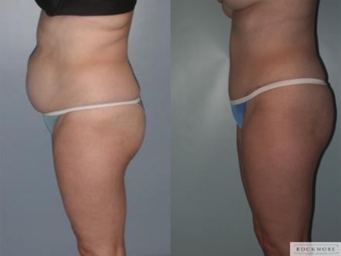Before & After Tummy Tuck Case 142 View #2 View in Albany & Latham, New York