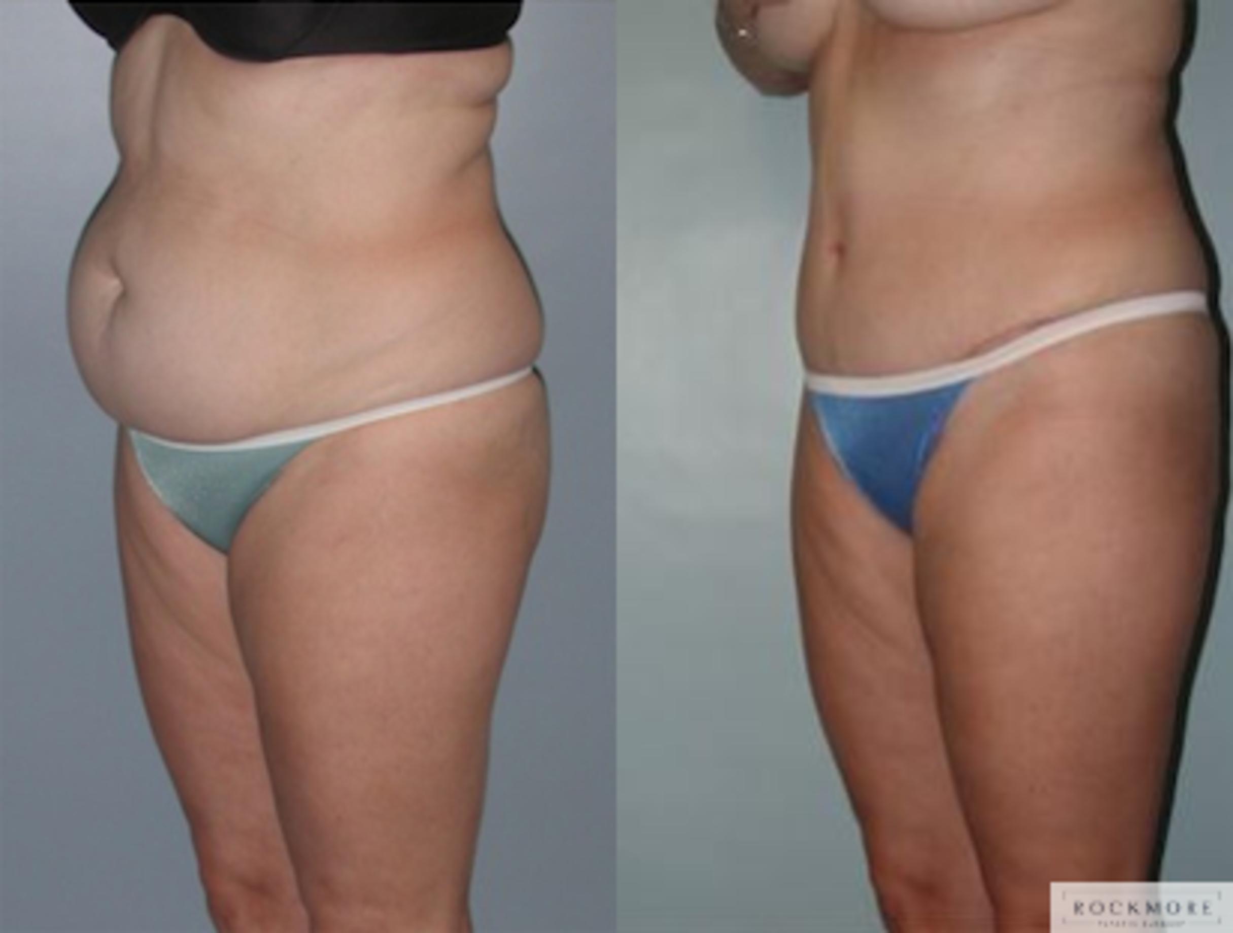 Before & After Tummy Tuck Case 142 View #3 View in Albany & Latham, New York