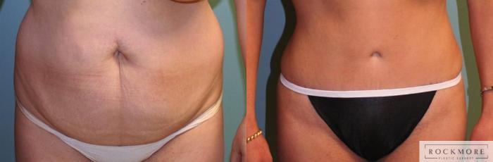 Before & After Tummy Tuck Case 159 View #1 View in Albany, Latham & Saratoga, New York