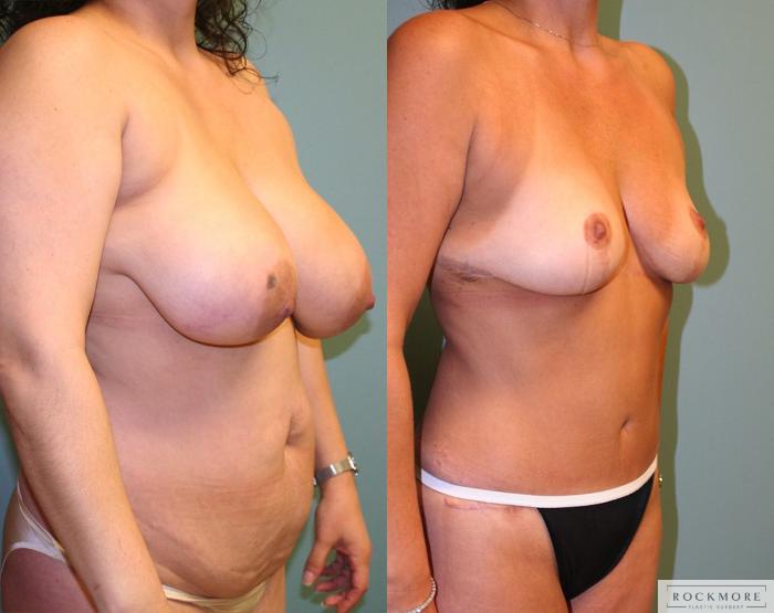 Before & After Tummy Tuck Case 159 View #4 View in Albany, Latham & Saratoga, New York