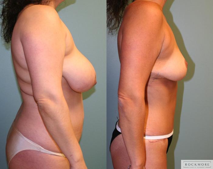 Before & After Tummy Tuck Case 159 View #5 View in Albany, Latham & Saratoga, New York