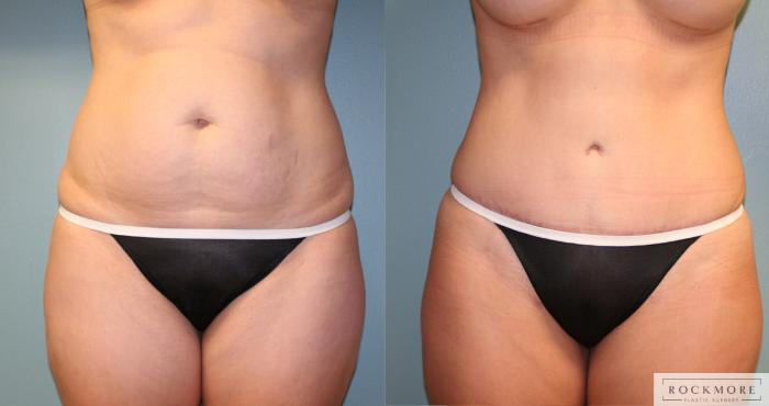 Before & After Tummy Tuck Case 173 View #1 View in Albany & Latham, New York