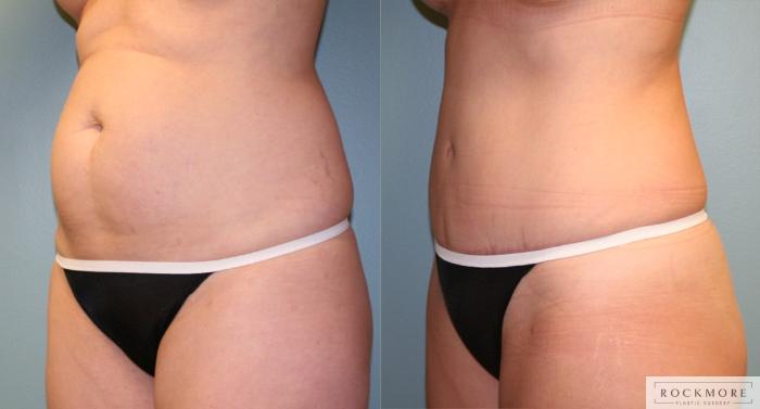 Before & After Tummy Tuck Case 173 View #2 View in Albany & Latham, New York