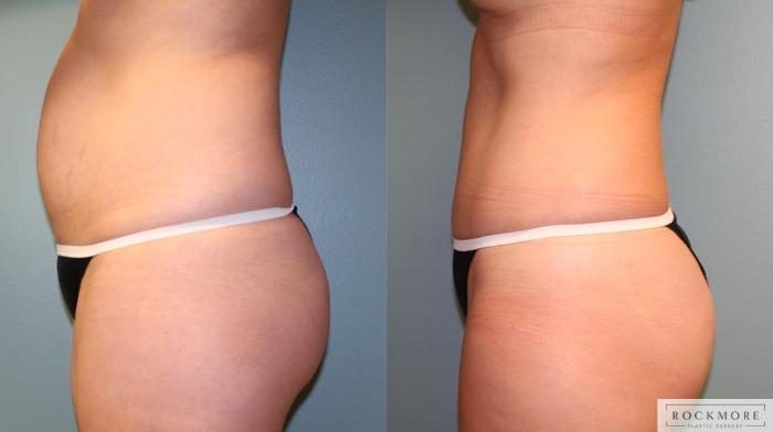 Before & After Tummy Tuck Case 173 View #3 View in Albany & Latham, New York