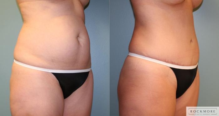 Before & After Tummy Tuck Case 173 View #4 View in Albany & Latham, New York