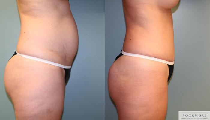 Before & After Tummy Tuck Case 173 View #5 View in Albany & Latham, New York