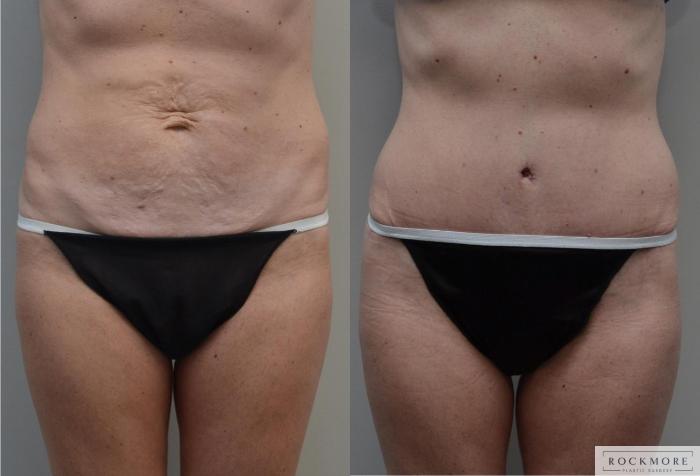 Before & After Tummy Tuck Case 183 View #1 View in Albany & Latham, New York