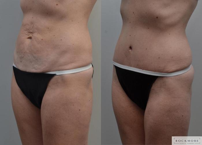 Before & After Tummy Tuck Case 183 View #2 View in Albany & Latham, New York