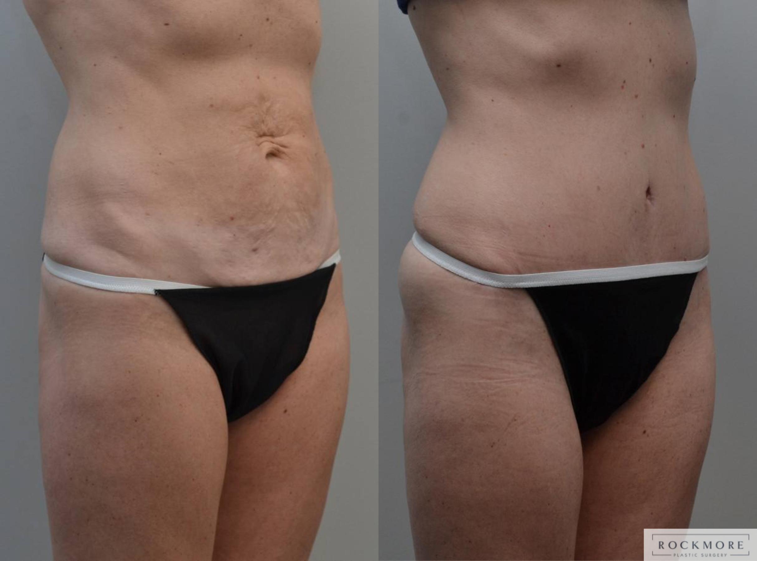 Before & After Tummy Tuck Case 183 View #3 View in Albany & Latham, New York