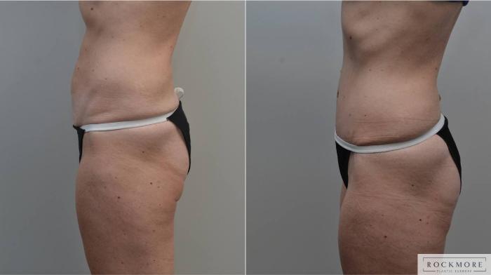 Before & After Tummy Tuck Case 183 View #4 View in Albany & Latham, New York