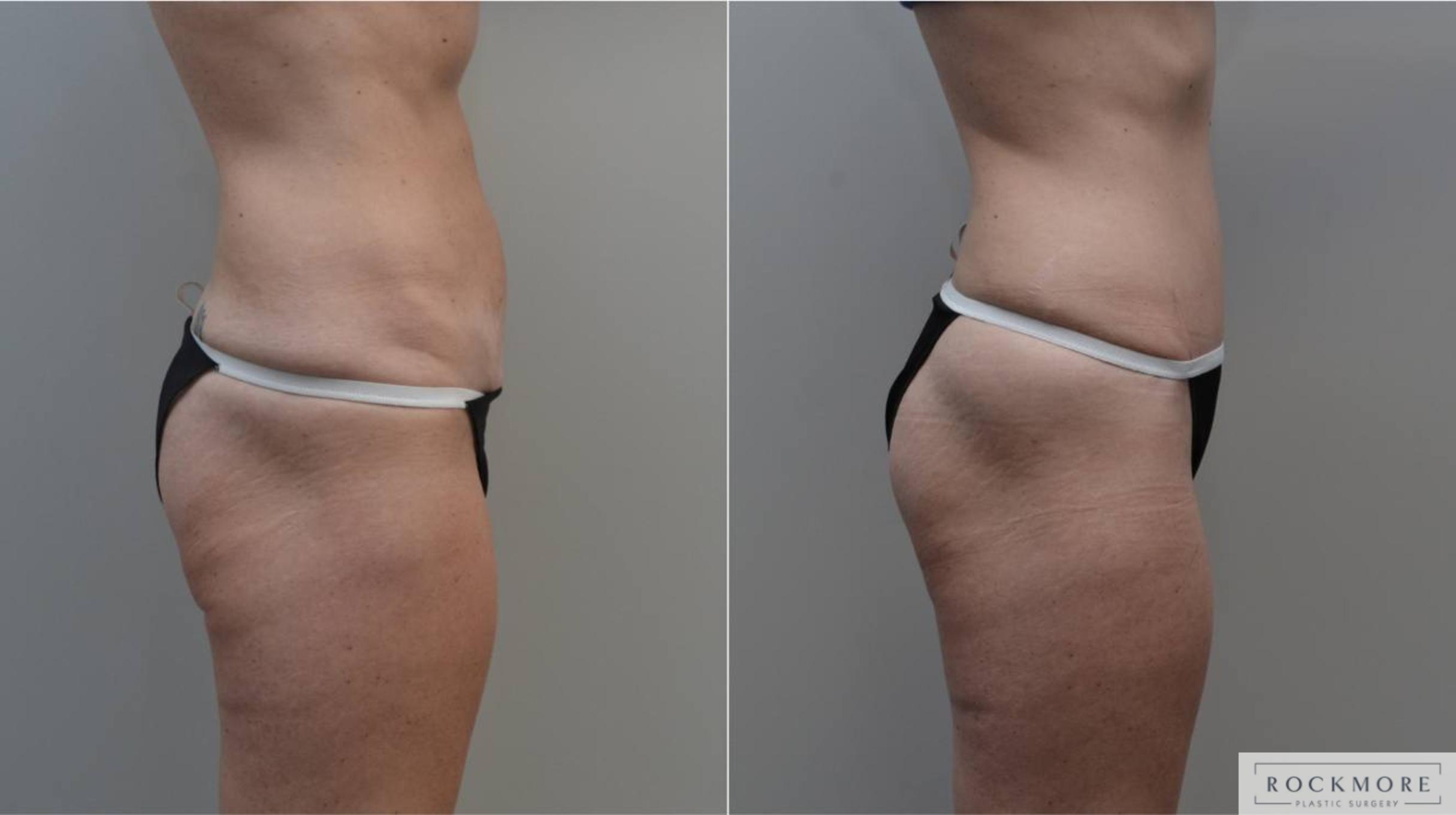 Before & After Tummy Tuck Case 183 View #5 View in Albany & Latham, New York