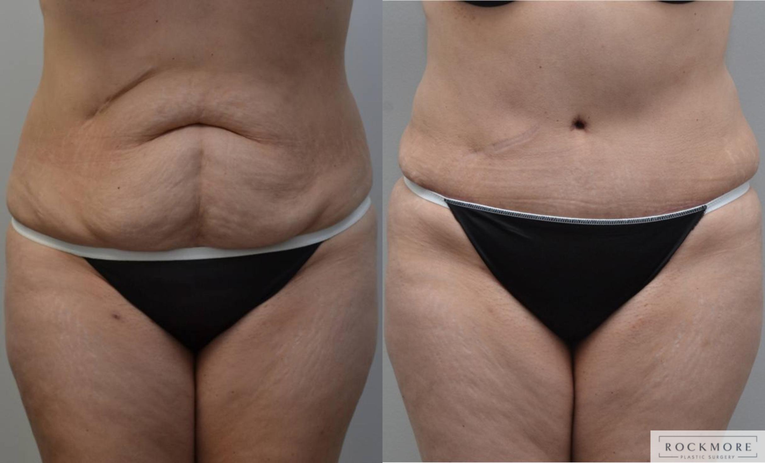 Before & After Tummy Tuck Case 184 View #1 View in Albany & Latham, New York