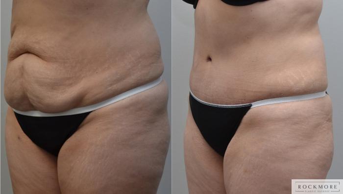 Before & After Tummy Tuck Case 184 View #2 View in Albany & Latham, New York