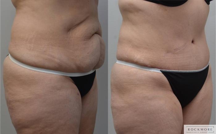 Before & After Tummy Tuck Case 184 View #3 View in Albany & Latham, New York